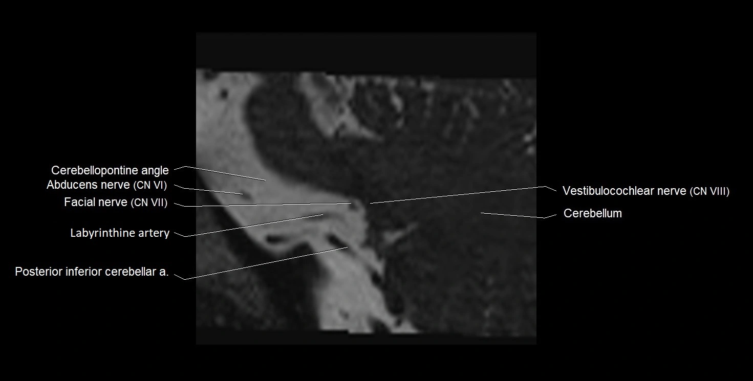 Internal auditory meatus (IAM) 3T sagittal cross sectional anatomy image 45.webp